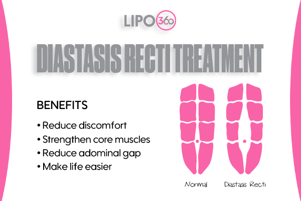 Revolutionising Muscle Repair: The Power of LIPO360 Body Sculpt Post-Injury 5 diastasis recti treatment Reigate