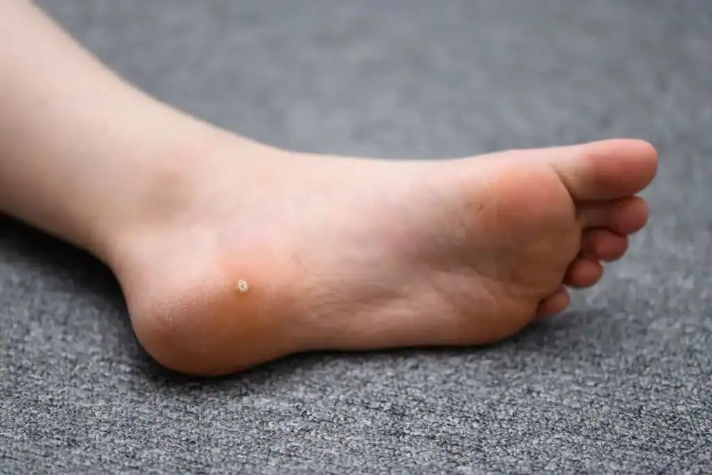 Cryotherapy For Warts And Also Verrucas 2 Image of verruca on the bottom of the foot that able to be treated with Cryotherapy Reigate