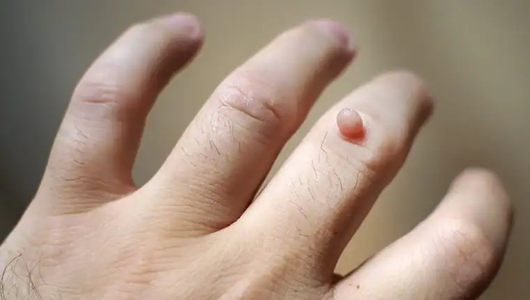 Image of blemish that Cryotherapy Reigate can remove with Lipo 360.