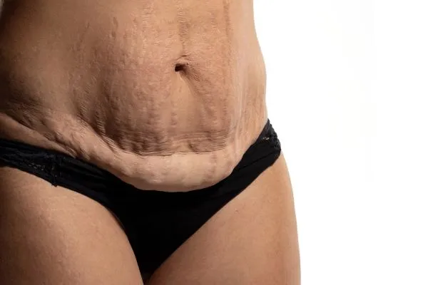 The science behind skin tightening Reigate picture of a woman's sagging skin on the stomach